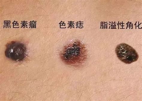 為何會長痣|痣變大、痣多或長毛會變皮膚癌？認識痣的形成與原因